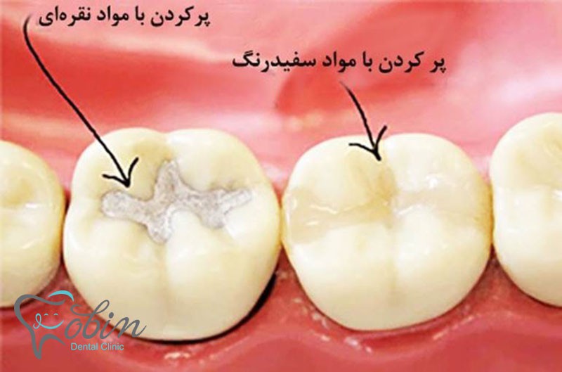 پر کردن دندان با کامپوزیت 